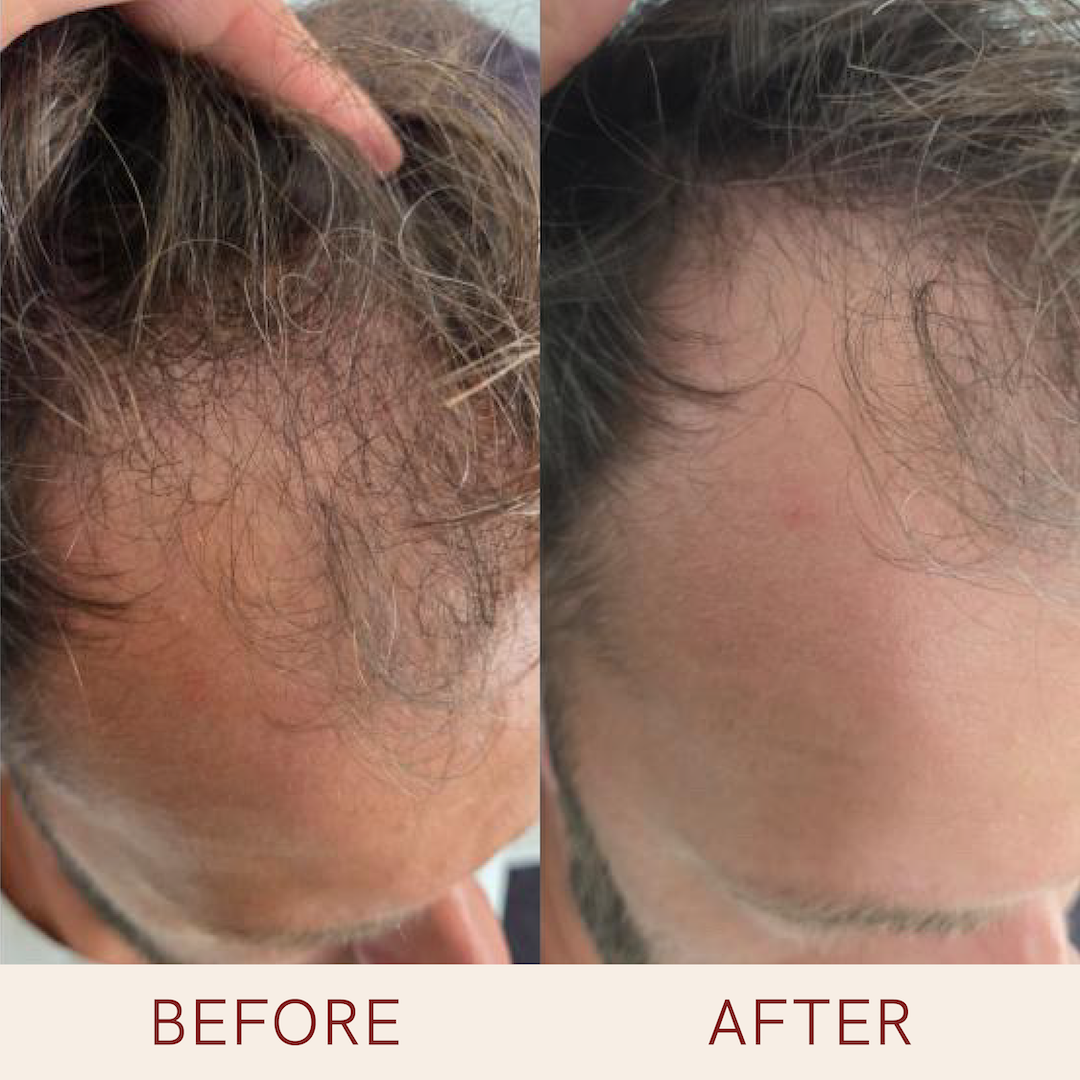 JUUKSEKASVU SEERUMI KUUR (3 kuud)